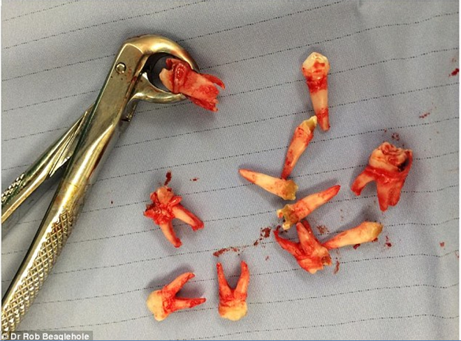 图为手术后拔掉的龋齿,儿童的牙齿已被糖腐蚀变形.
