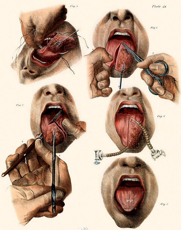 心疼古代人19世纪的外科手术图解