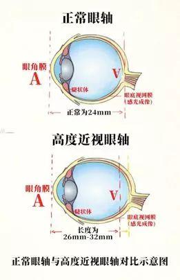 一般来说,正常人的眼轴约为24mm,而眼轴每增加1mm,近视度数就增加275