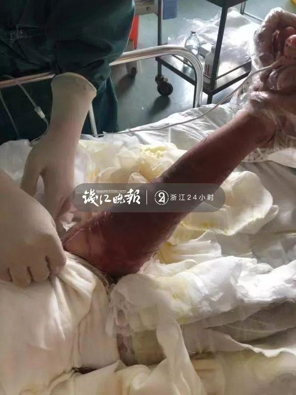 医生全力救治孩子转危为安 台州医院烧伤科主治医师王史辉在孩子送到