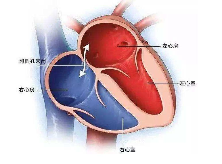 杭州小伙一声咳嗽后突然脑梗死!医生一查,心脏上有个洞