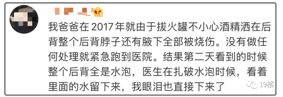 邓莎拔火罐被烧伤#的话题邓莎在微博上晒出了自己目前缠着纱布的照片