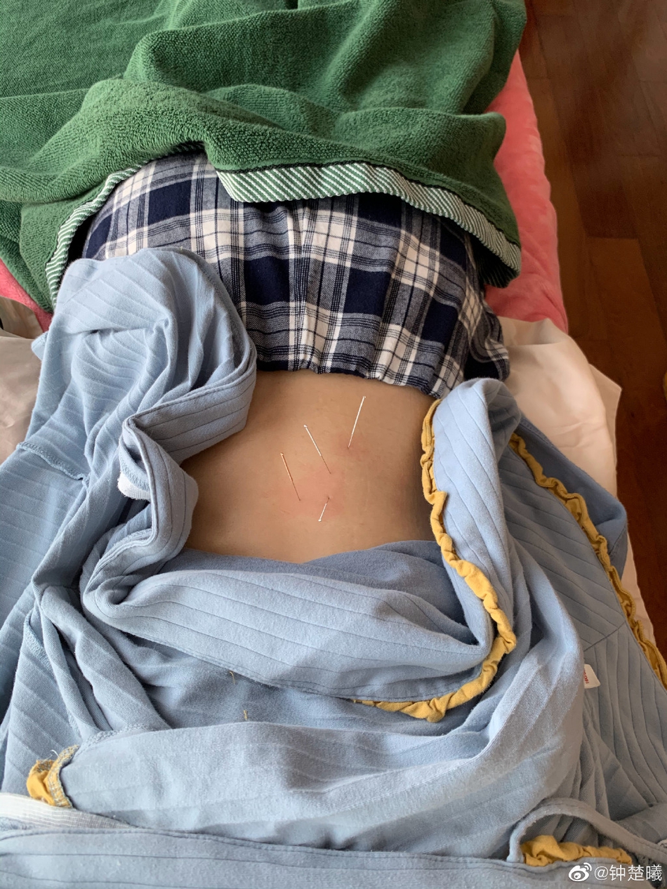 钟楚曦自曝腰韧带受伤 腰背部扎满针灸直呼动弹不得