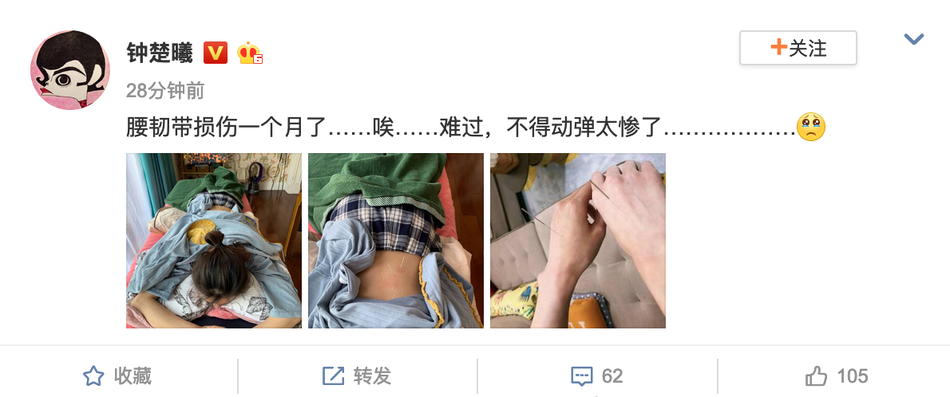 钟楚曦自曝腰韧带受伤 腰背部扎满针灸直呼动弹不得