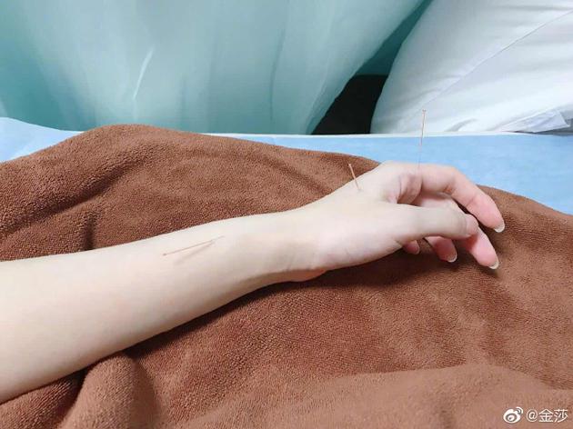 金莎晒医院针灸照 调侃修理四肢不协调的毛病