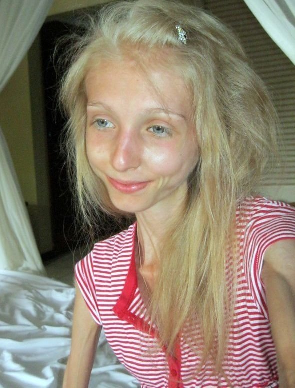 减肥达人俄罗斯女孩惊悚瘦身照