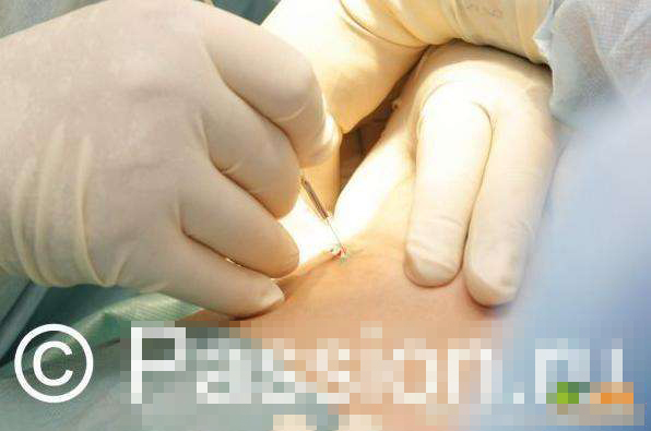 隆胸手术过程 假体图片