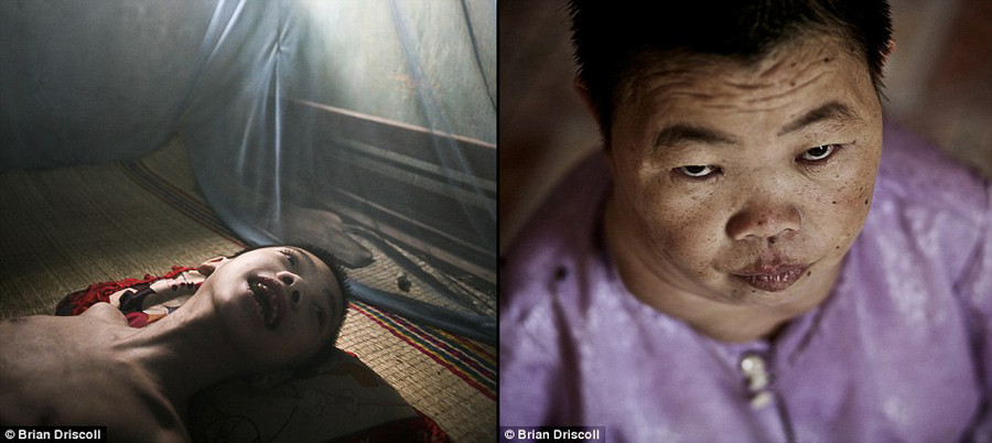 纽约摄影师揭秘越战美国化武受害者悲惨生活