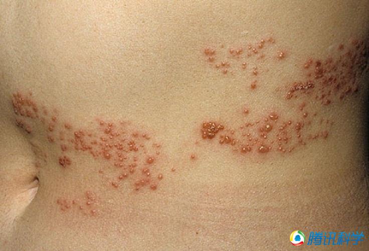 蜘蛛咬伤的五大可能后果等于服用超级伟哥