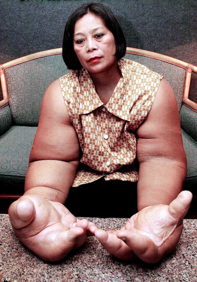 泰国女子患罕见病致其拥有世界上最大的手臂
