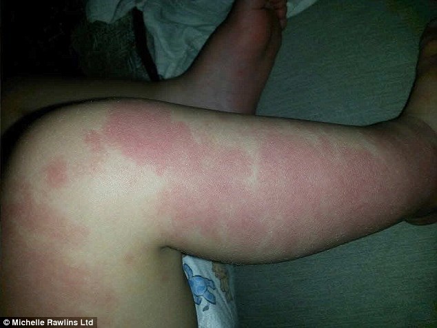 女儿腿上有巨大胎记父母纹同样花纹