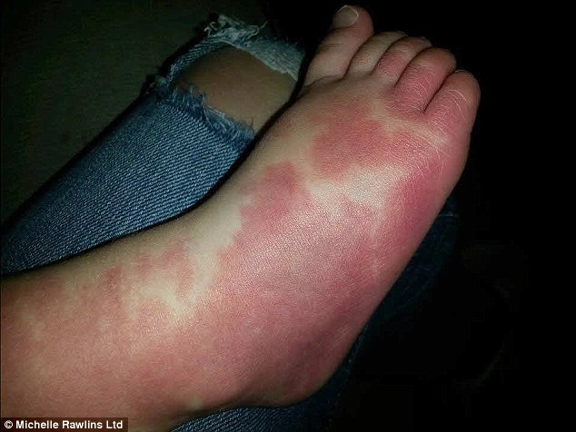 女儿腿上有巨大胎记 父母纹同样花纹