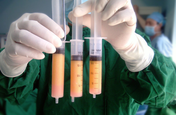 实拍女星丰胸抽脂手术全过程