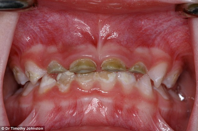 长期吃糖的牙齿图片图片