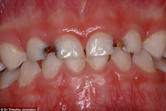 蛀牙因口腔细菌侵噬牙齿表面而形成,极大地损害了牙齿结构