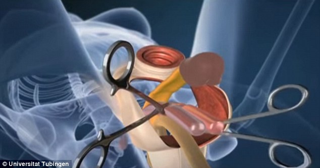 变性手术全过程3D动画图片
