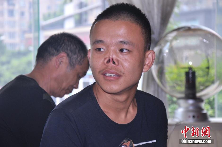 成都无鼻男孩装上新鼻开心自拍