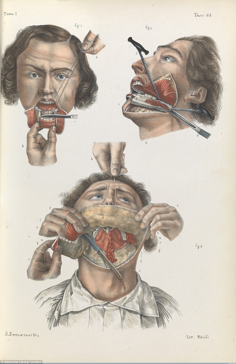 16 不忍直视!19世纪的外科手术竟是这样(组图)