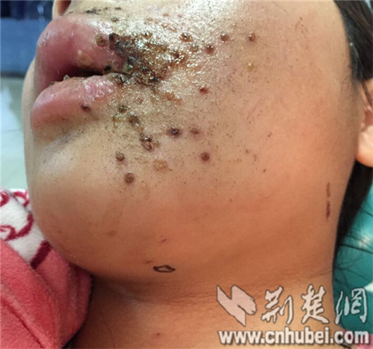 调皮弟弟玩射钉枪 姐姐被打成"筛子脸"(图)