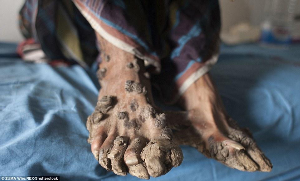 孟加拉国小伙身患怪病竟长成了一棵树