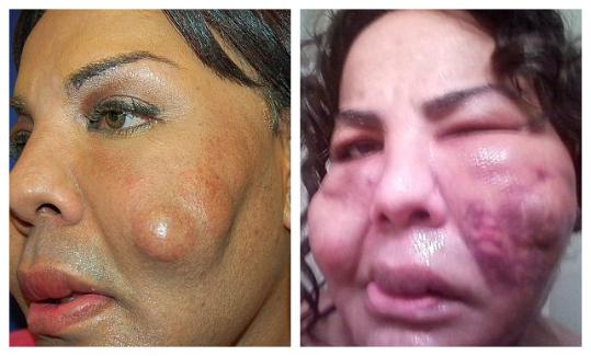 美变性女子黑市整容被毁容 全脸囊肿变"茄子"