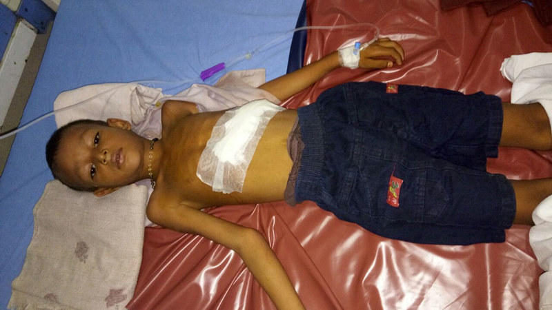 6岁男童体内取出未发育胚胎几率为500万分之一