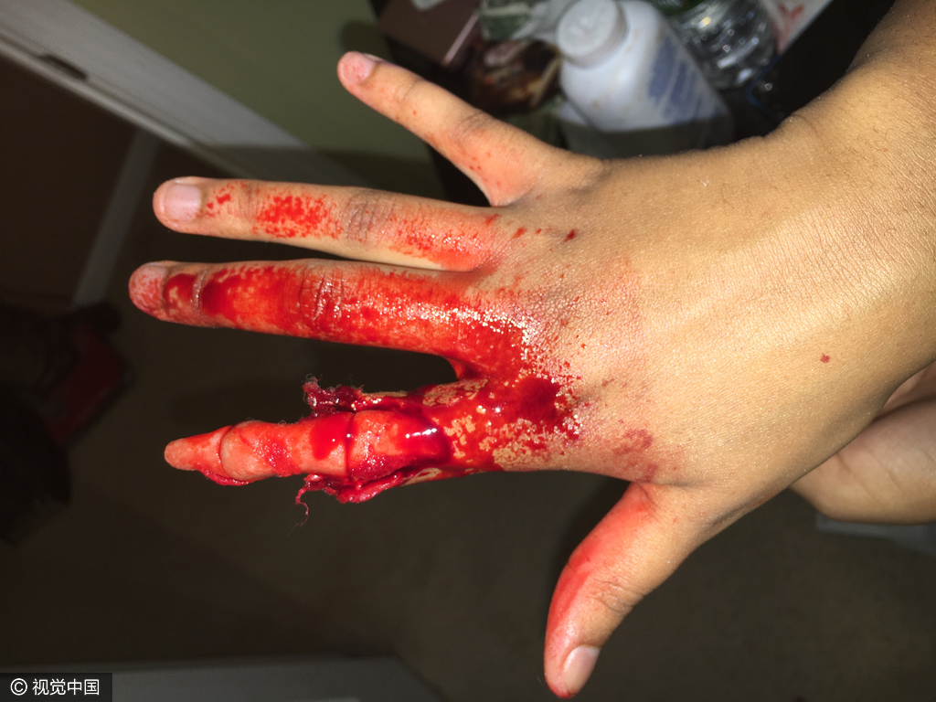 8 血腥慎点!美17岁化妆师超逼真受伤妆容