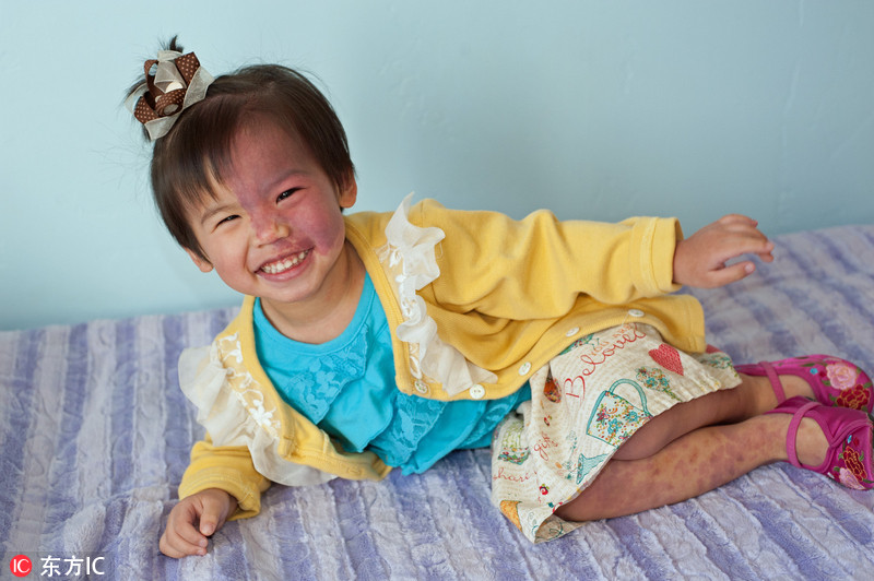 外国夫妻领养中国胎记女孩 缝制手工洋娃娃鼓励重拾信心