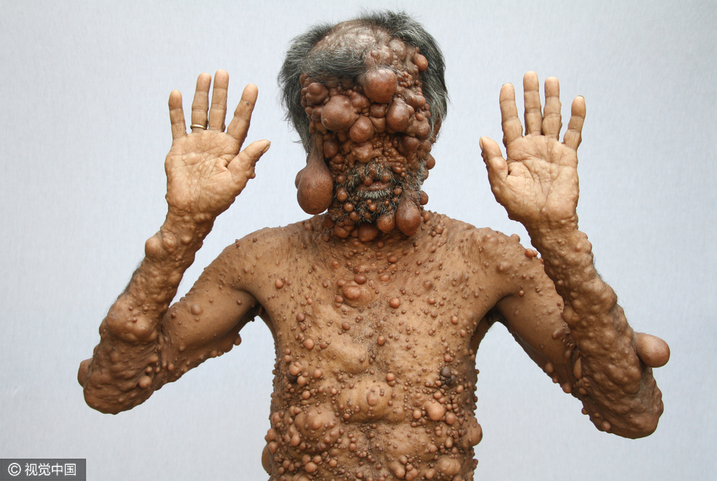 高能慎入孟加拉男子得怪病全身长满神经纤维瘤