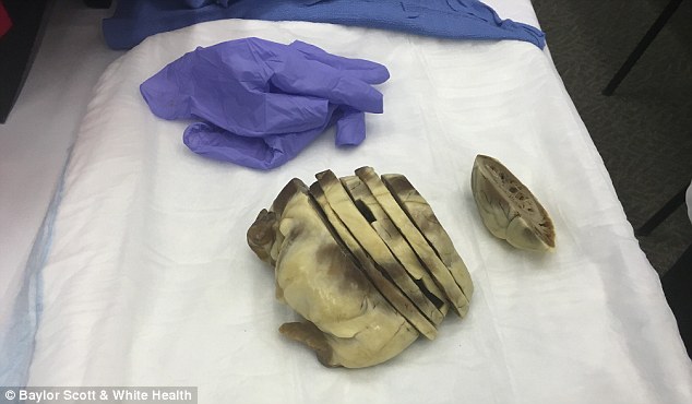 美医院让病人手捧被移植心脏 病人:看着像烤牛肉