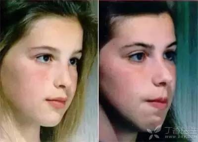 张嘴呼吸,越长越丑?终于找到变丑的原因了