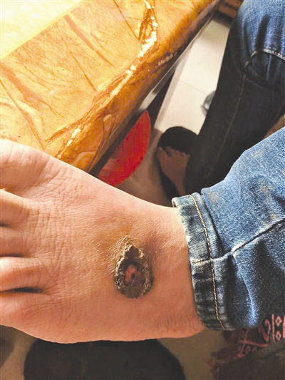 13岁少年离家上网21天 双脚溃烂险截肢(图)