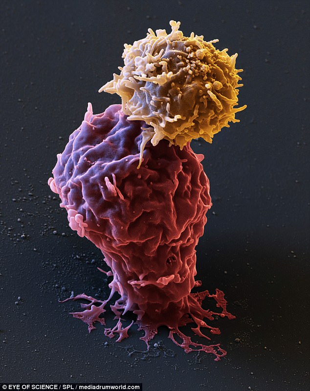 清晰彩色扫描照片展示免疫细胞与癌细胞搏斗
