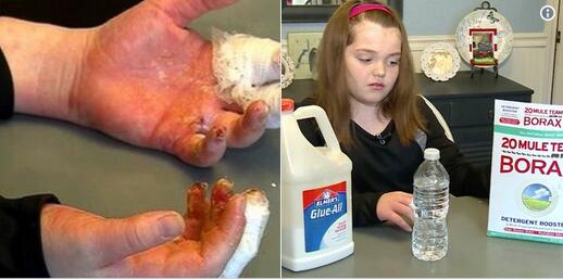 警惕儿童化学烧伤史莱姆软泥充当玩具需谨慎