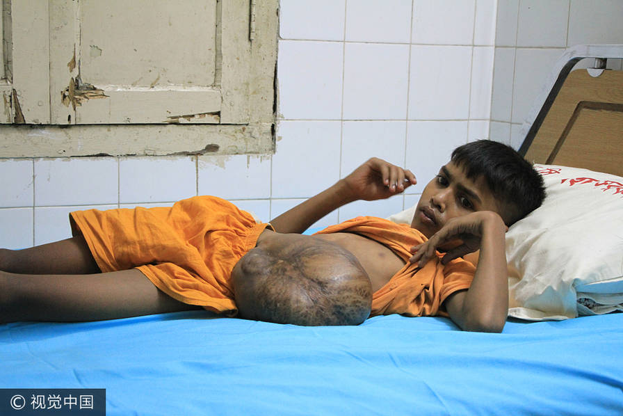 4 孟加拉国男童从出生开始抗癌 腹部"挂"巨型肿瘤