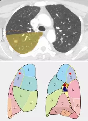 右肺叶间裂示意图图片