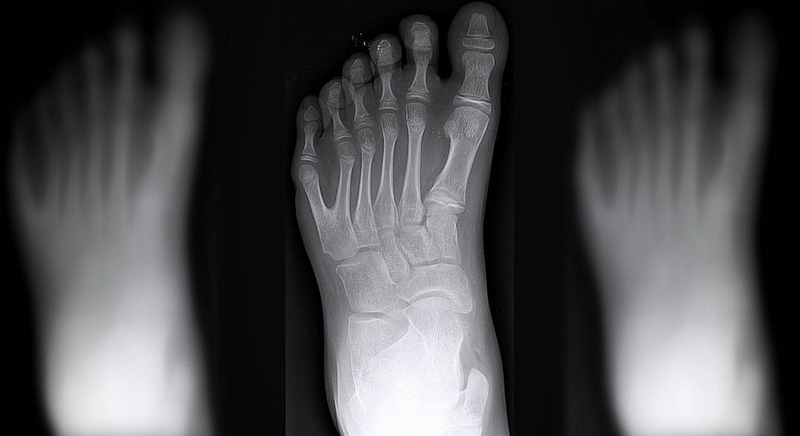 9 巴西"六指家族"迎小生命继承六指遗传