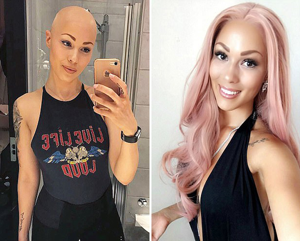 女子泰瑞莎汉森(therese hansson)在被诊断出患秃头症( alopecia)后