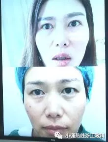 双眼皮医院排行榜_24岁女孩花4万割双眼皮,术后像42岁大妈,医院的回复让人气愤