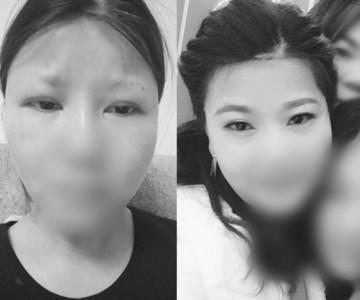 做双眼皮医院排行榜_河南郑州,女子花7万做双眼皮,最后收费20万,医院:你签了字的(2)
