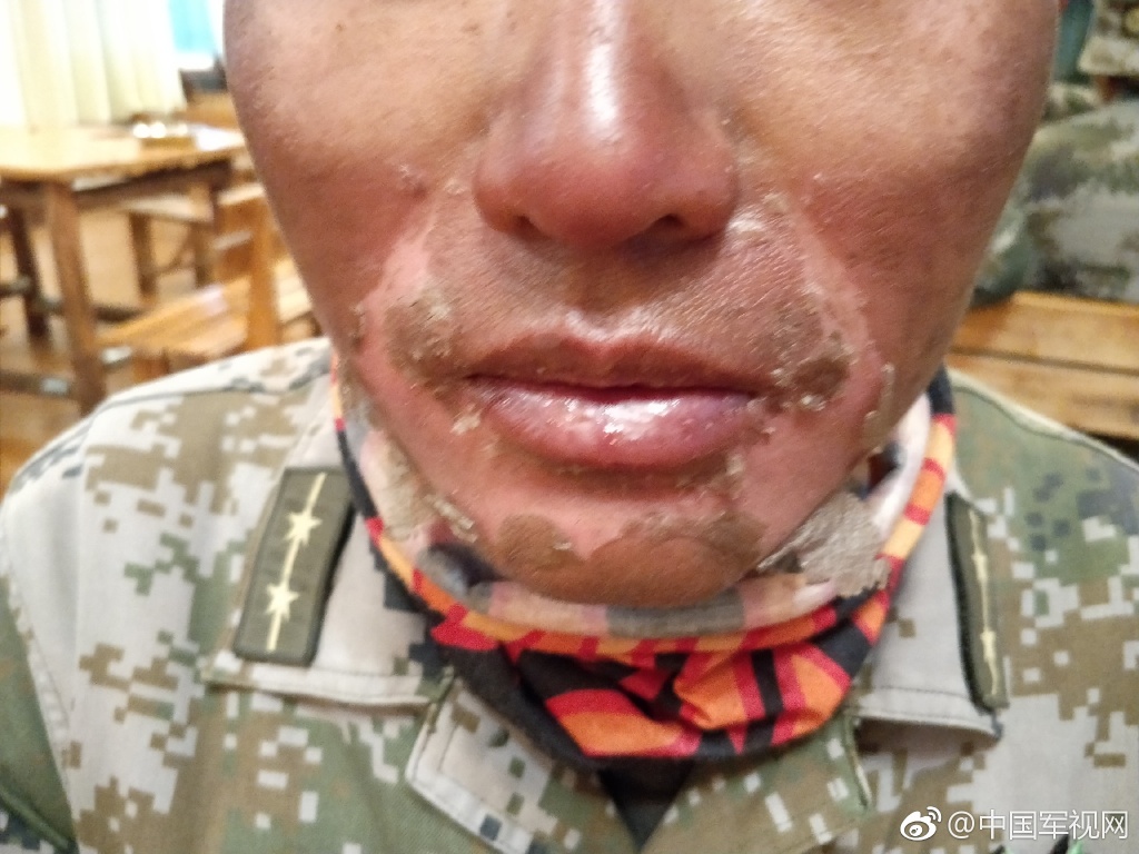 高原战士冻伤的脸图片
