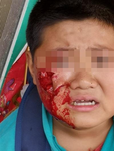 恶犬发疯接连咬人 男孩上学路上脸颊被咬出大洞