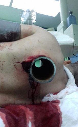 奇迹俄男子遇车祸被粗钢管穿胸而过仍生还