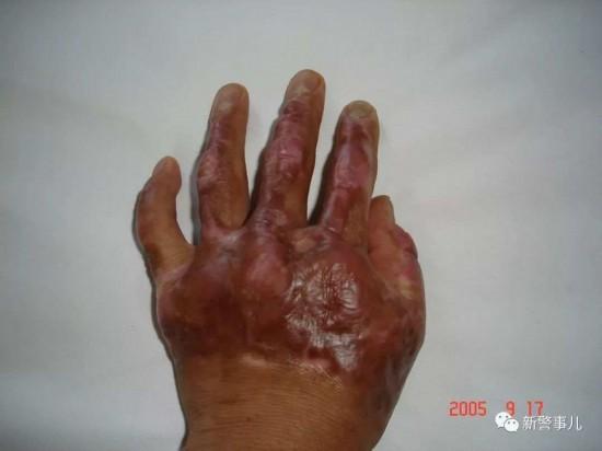 事故,张保国全身有8%的面积烧伤,其中双手深二度烧伤,落下七级伤残