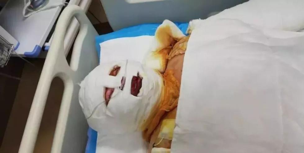 把一整条腿的皮割给了女儿他说若需要另一条也割