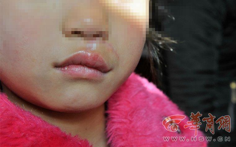 7岁女童刚进校门被村支书的狗咬穿嘴唇 缝十多针