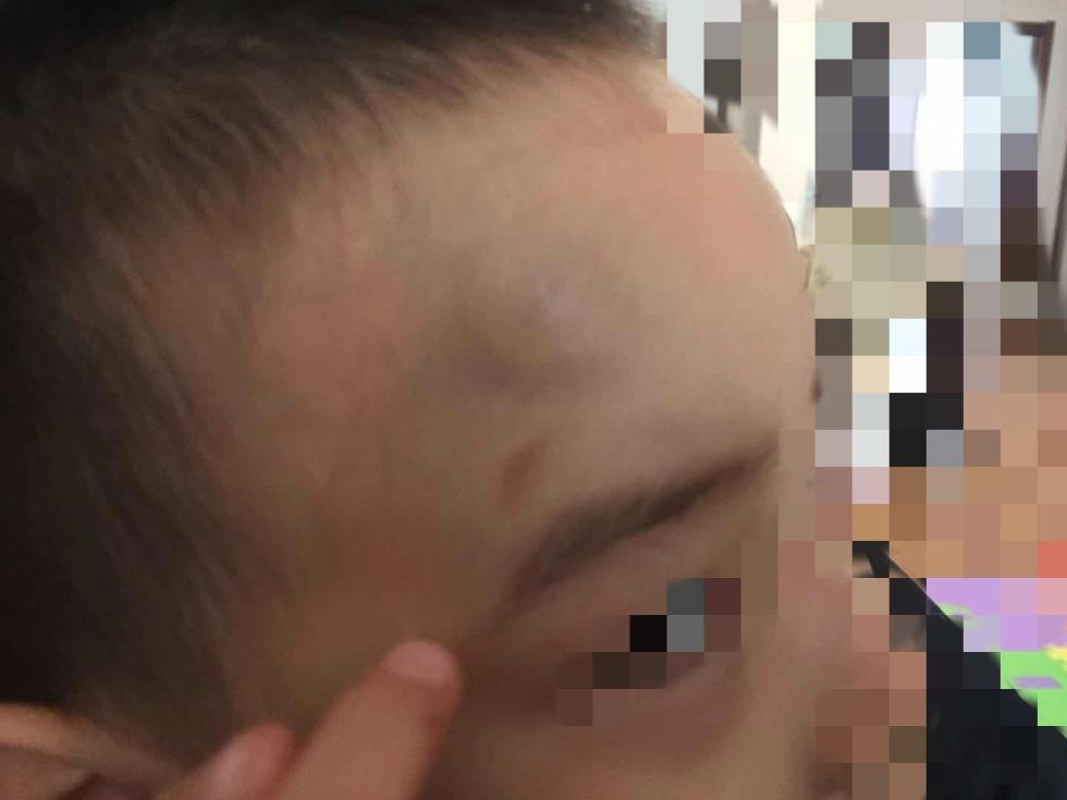 男童头部的淤青和刮痕监控显示老师用脚踢孩子