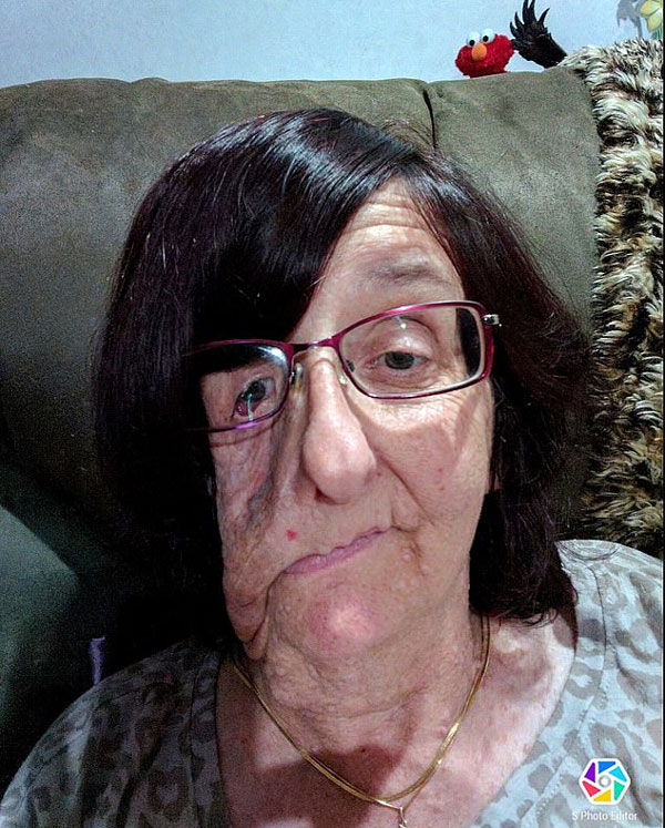 新西兰面部畸形女子饱受折磨数十年终释怀