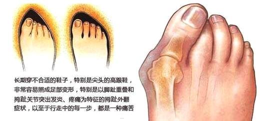 有网友说宋茜的脚会这样是因为常年穿高跟鞋,而且还跳舞才导致这样的。