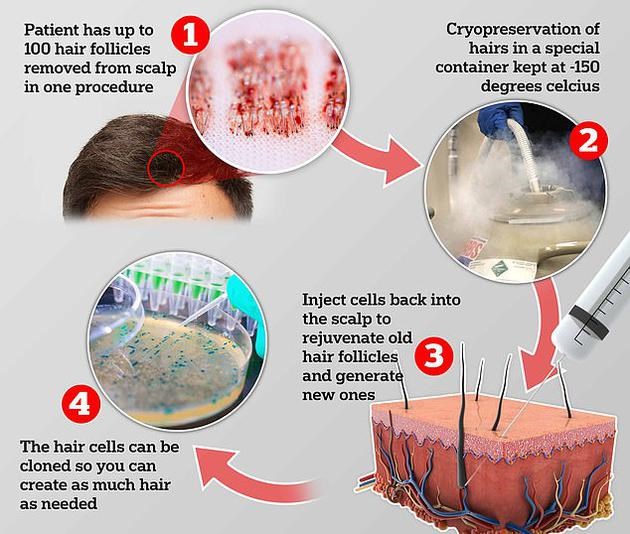 为应对脱发困扰 英国推出“克隆”毛囊技术